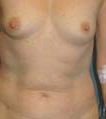 Breast Augmentation Results Rockville MD